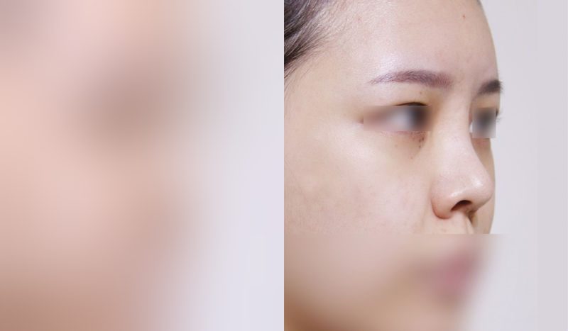 Rhinoplasty before-and-after comparison photo — before surgery on the left, after surgery on the right. Nasal bridge + tip correction (septal cartilage) + lateral and medial cartilage + dorsal hump removal + bulbous nose