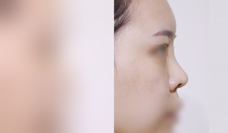Rhinoplasty before-and-after comparison photo — before surgery on the left, after surgery on the right. Nasal bridge + tip correction (septal cartilage) + lateral and medial cartilage + dorsal hump removal + bulbous nose