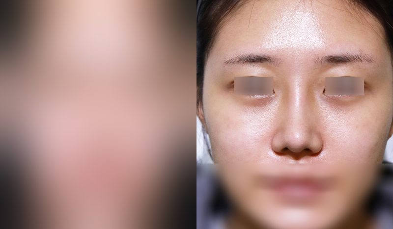 Rhinoplasty before-and-after comparison photo — before surgery on the left, after surgery on the right. Nasal bridge + tip correction (septal cartilage) + dorsal hump removal + bulbous nose
