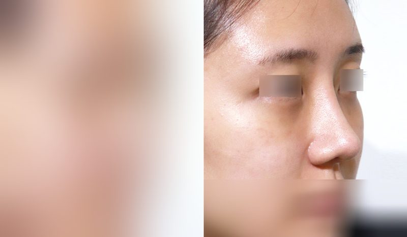 Rhinoplasty before-and-after comparison photo — before surgery on the left, after surgery on the right. Nasal bridge + tip correction (septal cartilage) + dorsal hump removal + bulbous nose