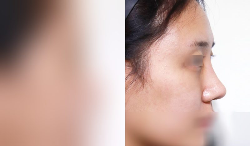 Rhinoplasty before-and-after comparison photo — before surgery on the left, after surgery on the right. Nasal bridge + tip correction (septal cartilage) + dorsal hump removal + bulbous nose