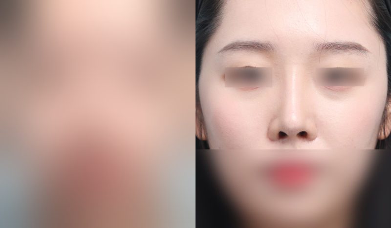 Rhinoplasty before-and-after comparison photo — before surgery on the left, after surgery on the right. Nasal bridge + tip correction (septal cartilage) + dorsal hump removal + lateral and medial osteotomy + bulbous nose