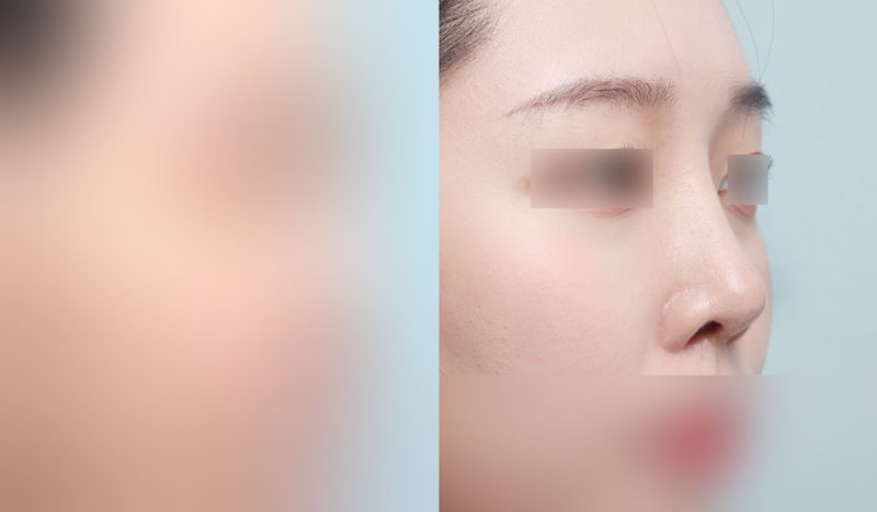 Rhinoplasty before-and-after comparison photo — before surgery on the left, after surgery on the right. Nasal bridge + tip correction (septal cartilage) + dorsal hump removal + lateral and medial osteotomy + bulbous nose