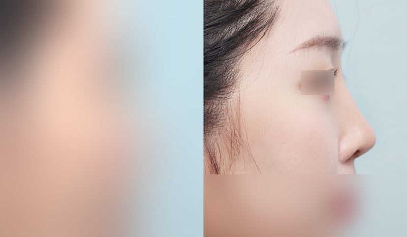 Rhinoplasty before-and-after comparison photo — before surgery on the left, after surgery on the right. Nasal bridge + tip correction (septal cartilage) + dorsal hump removal + lateral and medial osteotomy + bulbous nose