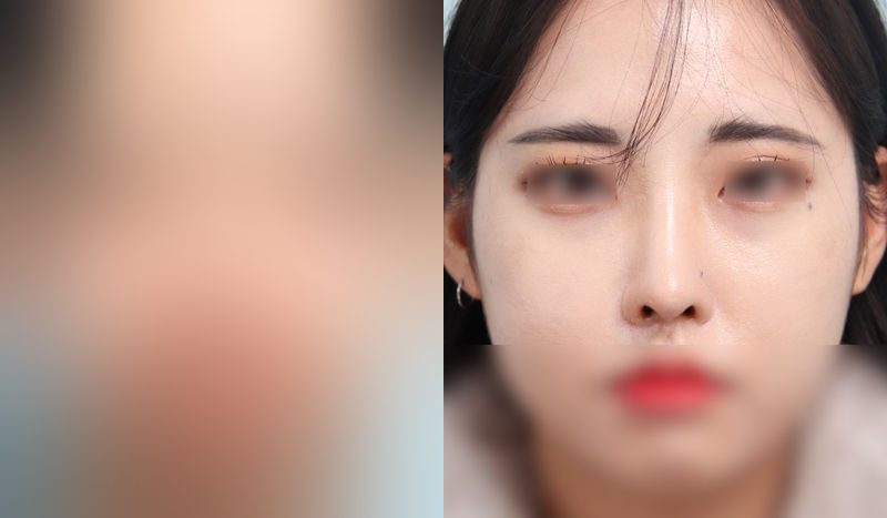 Nose surgery before-and-after comparison — left is before surgery, right is after. Nasal Bridge + Tip Correction (Septal) + Dorsal Hump Removal