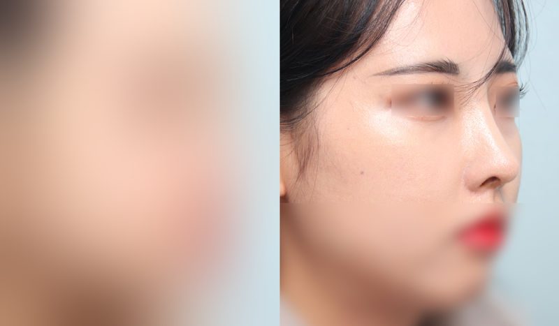 Nose surgery before-and-after comparison — left is before surgery, right is after. Nasal Bridge + Tip Correction (Septal) + Dorsal Hump Removal