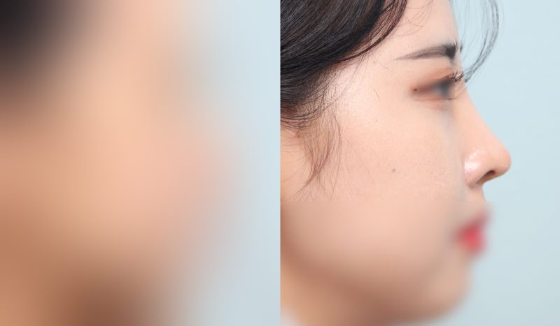 Nose surgery before-and-after comparison — left is before surgery, right is after. Nasal Bridge + Tip Correction (Septal) + Dorsal Hump Removal