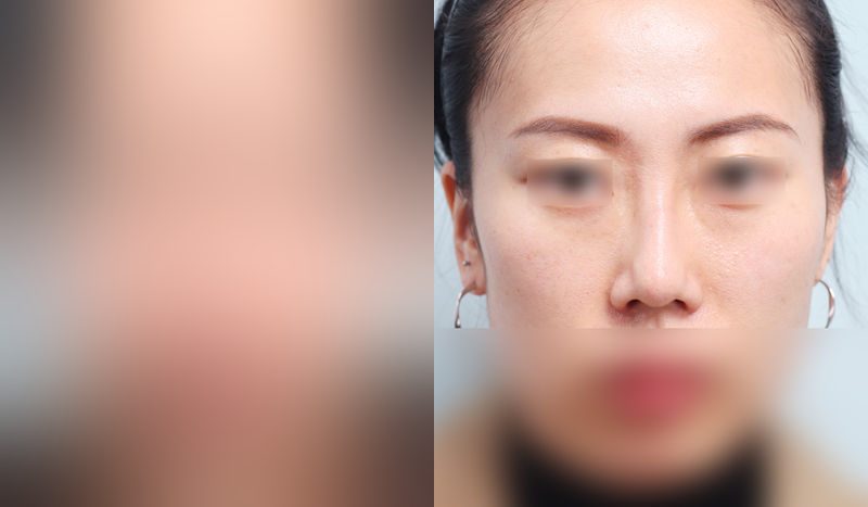 Before-and-after nose surgery photos — before surgery on the left, after surgery on the right. Revision rhinoplasty + tip correction (septal cartilage) + dorsal hump reduction