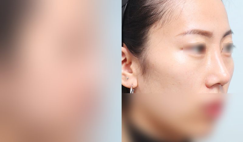 Before-and-after nose surgery photos — before surgery on the left, after surgery on the right. Revision rhinoplasty + tip correction (septal cartilage) + dorsal hump reduction