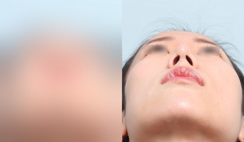 Before-and-after nose surgery photos — before surgery on the left, after surgery on the right. Revision rhinoplasty + tip correction (septal cartilage) + dorsal hump reduction
