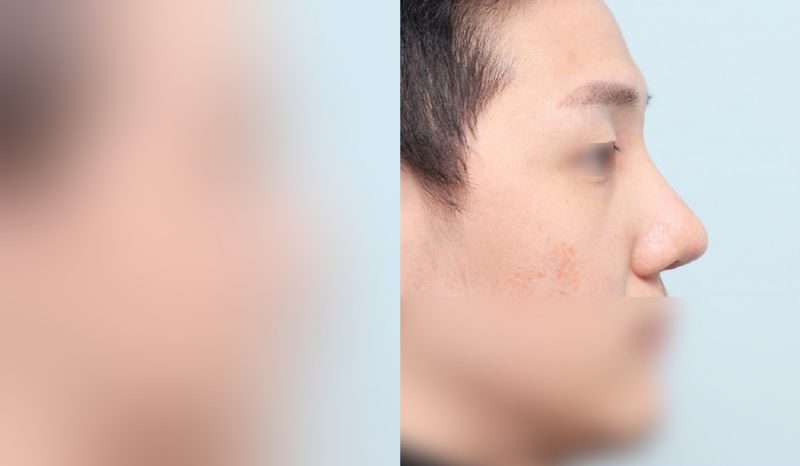 Before-and-after photos of rhinoplasty — before surgery on the left, after surgery on the right. Male revision rhinoplasty + tip correction (septal) + hump nose + lateral and medial osteotomy