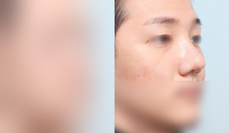 Before-and-after photos of rhinoplasty — before surgery on the left, after surgery on the right. Revision rhinoplasty + tip correction (septal) + hump nose + lateral and medial osteotomy