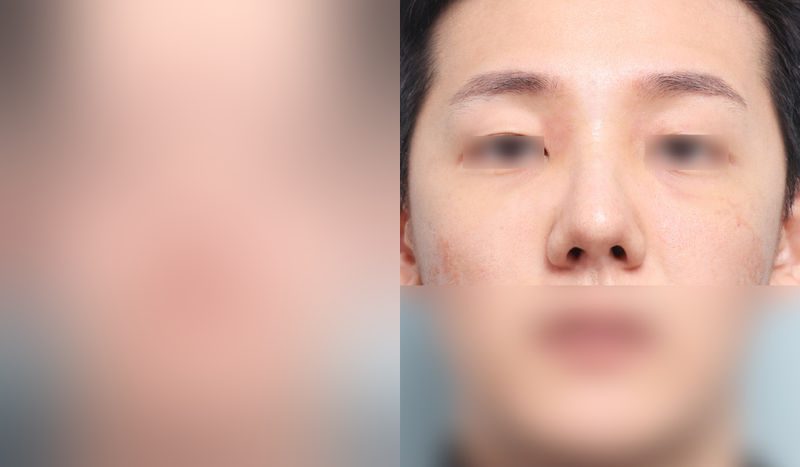Before-and-after photos of rhinoplasty — before surgery on the left, after surgery on the right. Male revision rhinoplasty + tip correction (septal) + hump nose + lateral and medial osteotomy