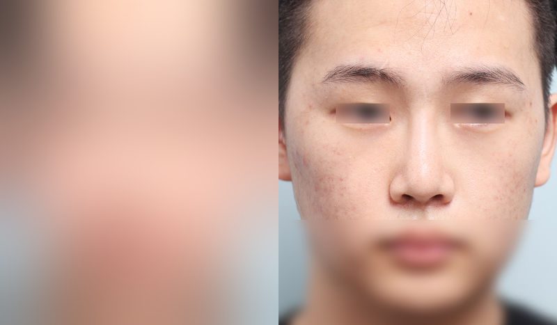 Before-and-after photos of rhinoplasty — before surgery on the left, after surgery on the right. Nasal bridge + nasal tip (septal) + hump nose + bulbous nose