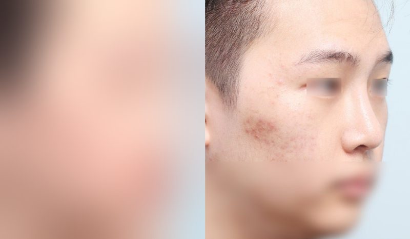 Before-and-after photos of rhinoplasty — before surgery on the left, after surgery on the right. Nasal bridge + nasal tip (septal) + hump nose + bulbous nose