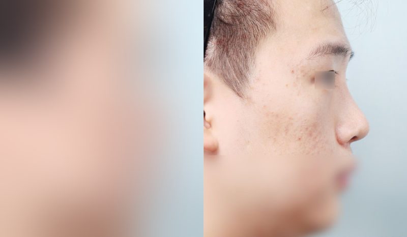 Before-and-after photos of rhinoplasty — before surgery on the left, after surgery on the right. Nasal bridge + nasal tip (septal) + hump nose + bulbous nose