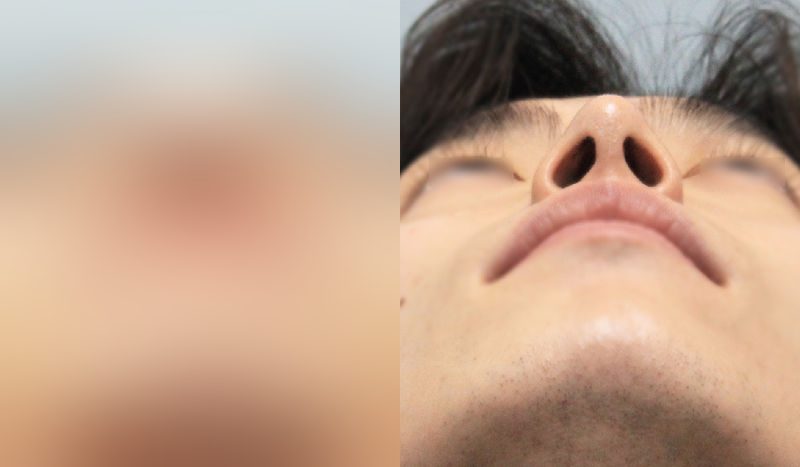 Before-and-after photos of rhinoplasty — before surgery on the left, after surgery on the right. Autologous dermis rhinoplasty + hump nose + alar reduction