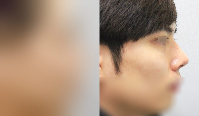 Before-and-after photos of rhinoplasty — before surgery on the left, after surgery on the right. Autologous dermis rhinoplasty + hump nose + alar reduction