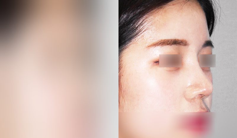 Before-and-after photos of rhinoplasty — before surgery on the left, after surgery on the right. Nasal bridge + nasal tip (septal)