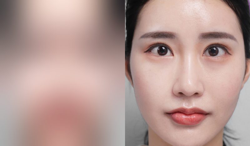 Before-and-after photos of rhinoplasty — before surgery on the left, after surgery on the right. Nasal bridge + nasal tip (septal) + hump nose + arrow nose correction + incisional double eyelid surgery (revision) + eye shape correction + combined canthoplasty
