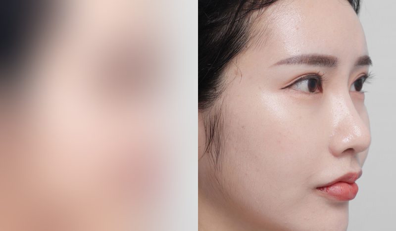 Before-and-after photos of rhinoplasty — before surgery on the left, after surgery on the right. Nasal bridge + nasal tip (septal) + hump nose + arrow nose correction + incisional double eyelid surgery (revision) + eye shape correction + combined canthoplasty
