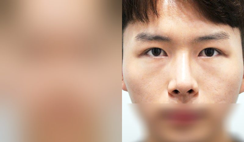 Before-and-after photos of rhinoplasty — before surgery on the left, after surgery on the right. Nasal bridge + nasal tip (septal) + hump nose + crooked nose correction + lateral osteotomy + incisional double eyelid surgery (revision) + eye shape correction + epicanthoplasty