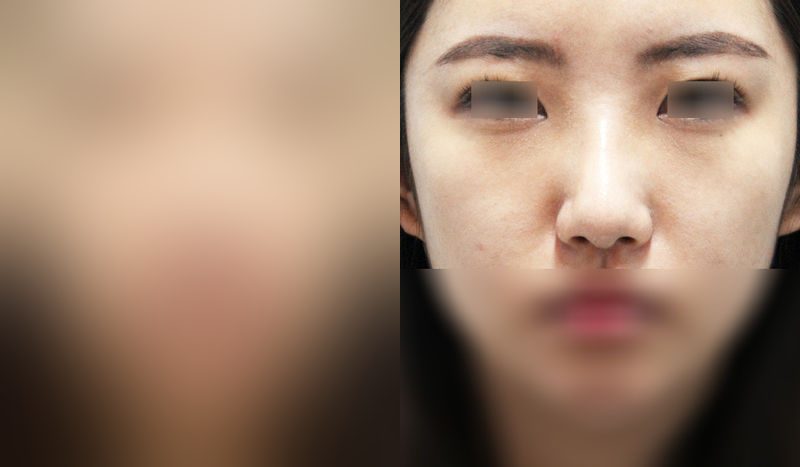 Before-and-after photos of rhinoplasty — before surgery on the left, after surgery on the right. Nasal bridge + nasal tip (septal) + hump nose + lateral and medial osteotomy
