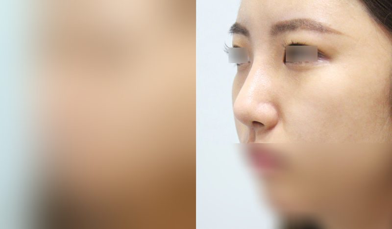 Before-and-after photos of rhinoplasty — before surgery on the left, after surgery on the right. Nasal bridge + nasal tip (septal) + hump nose + lateral and medial osteotomy