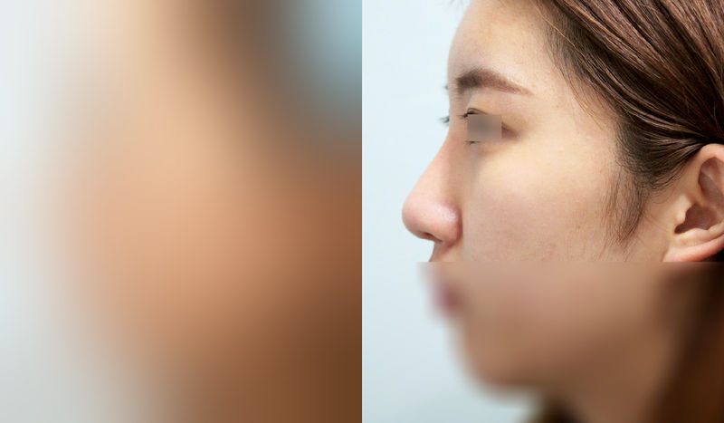 Before-and-after photos of rhinoplasty — before surgery on the left, after surgery on the right. Nasal bridge + nasal tip (septal) + hump nose + lateral and medial osteotomy
