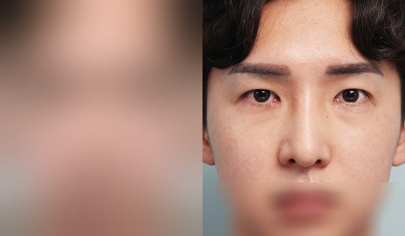 Before-and-after photos of rhinoplasty — before surgery on the left, after surgery on the right. Nasal bridge + nasal tip (septal) + hump nose + lateral osteotomy + incisional double eyelid surgery + eye shape correction + epicanthoplasty