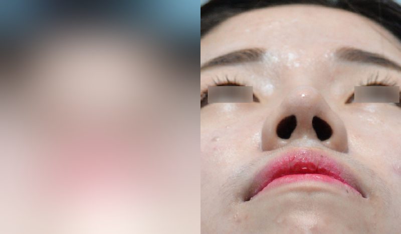 Before-and-after photos of rhinoplasty — before surgery on the left, after surgery on the right. Nasal bridge + nasal tip (septal)