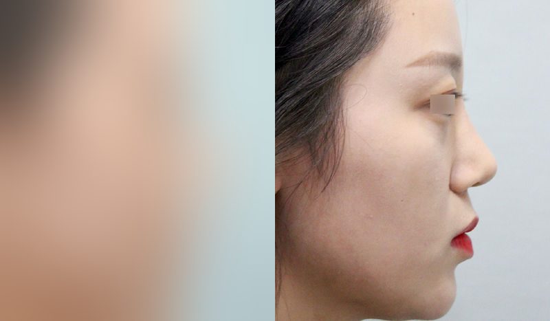 Before-and-after photos of rhinoplasty — before surgery on the left, after surgery on the right. Nasal bridge + nasal tip (septal) + hump nose + lateral osteotomy