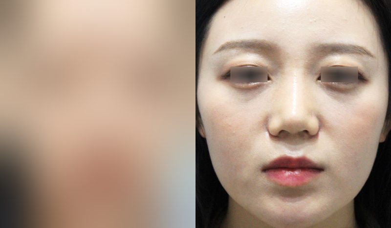 Before-and-after photos of rhinoplasty — before surgery on the left, after surgery on the right. Nasal bridge + nasal bridge + nasal tip (septal) + hump nose + lateral osteotomy