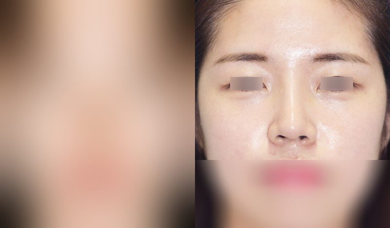 Before-and-after photos of rhinoplasty — before surgery on the left, after surgery on the right. Nasal bridge + nasal tip (septal)