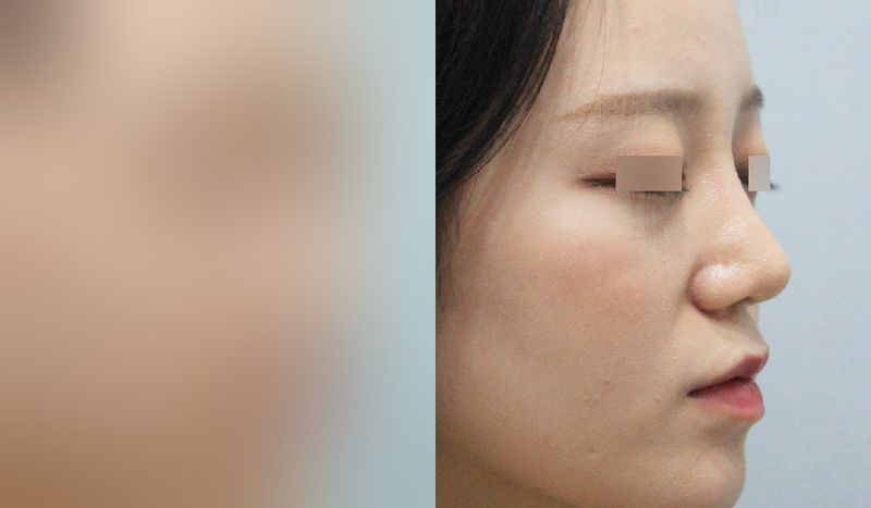 Before-and-after photos of rhinoplasty — before surgery on the left, after surgery on the right. Rhinoplasty + hump nose + lateral osteotomy + septal surgery