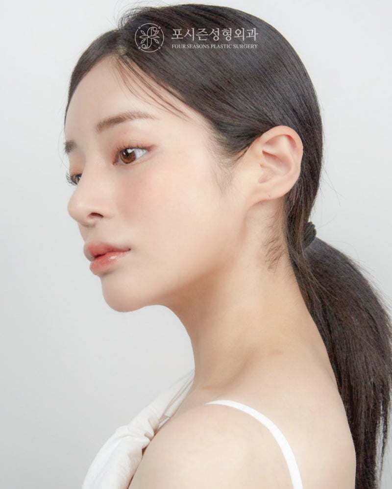 Rhinoplasty Revision: Analysis of Causes by Type Before Proceeding