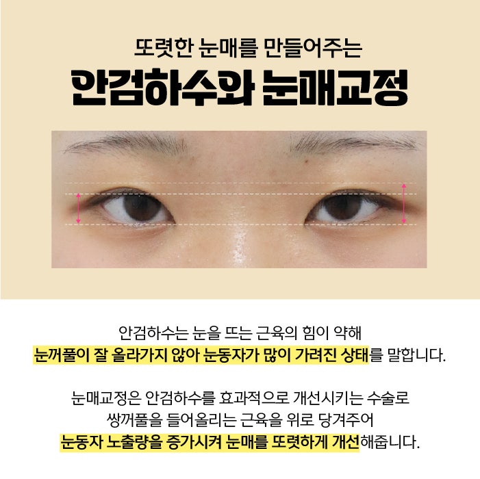 Busan Eye Surgery: Which Method is Right for Me?