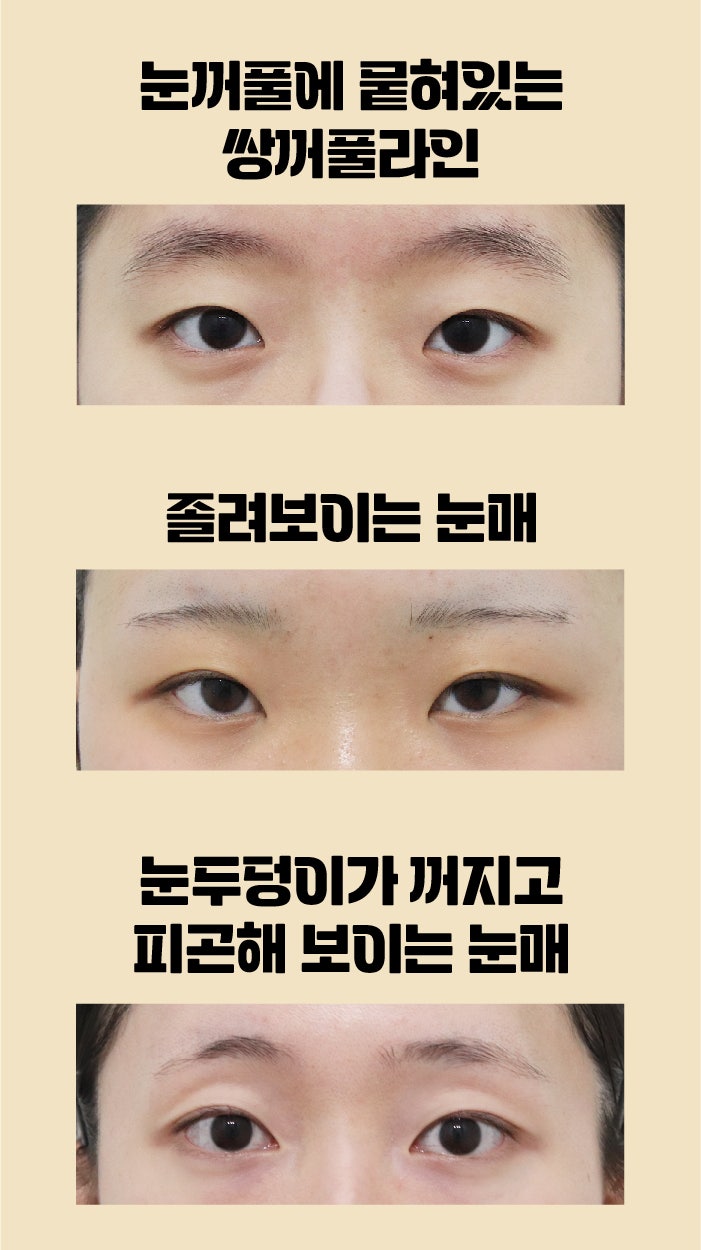 Busan Eye Surgery: Which Method is Right for Me?