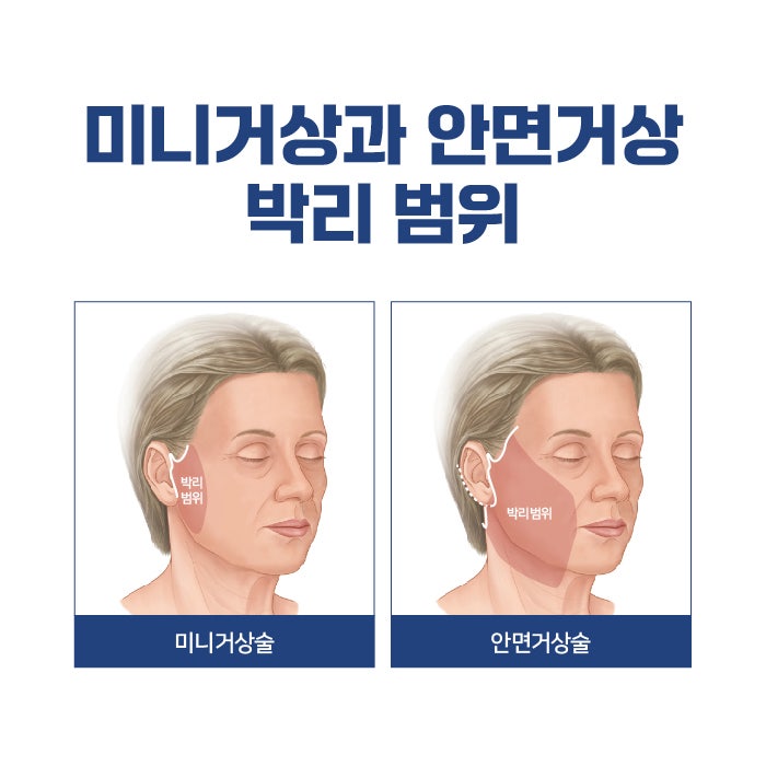 Various Types and Surgical Methods of Busan Lifting