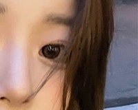 Why is Seomyeon Eye Revision Surgery More Difficult and Requires Greater Caution?