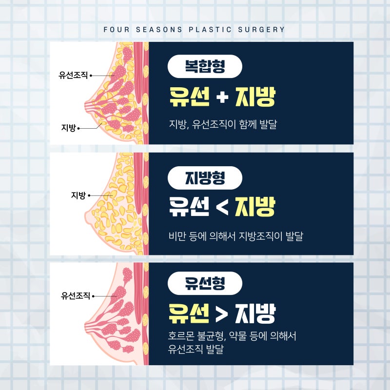 การผ่าตัดแก้ไขภาวะหน้าอกโตในผู้ชายที่ปูซาน: ตั้งแต่สาเหตุจนถึงการรักษา