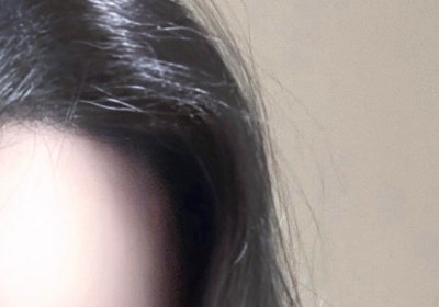 What are the key factors determining the outcome of eye surgery?