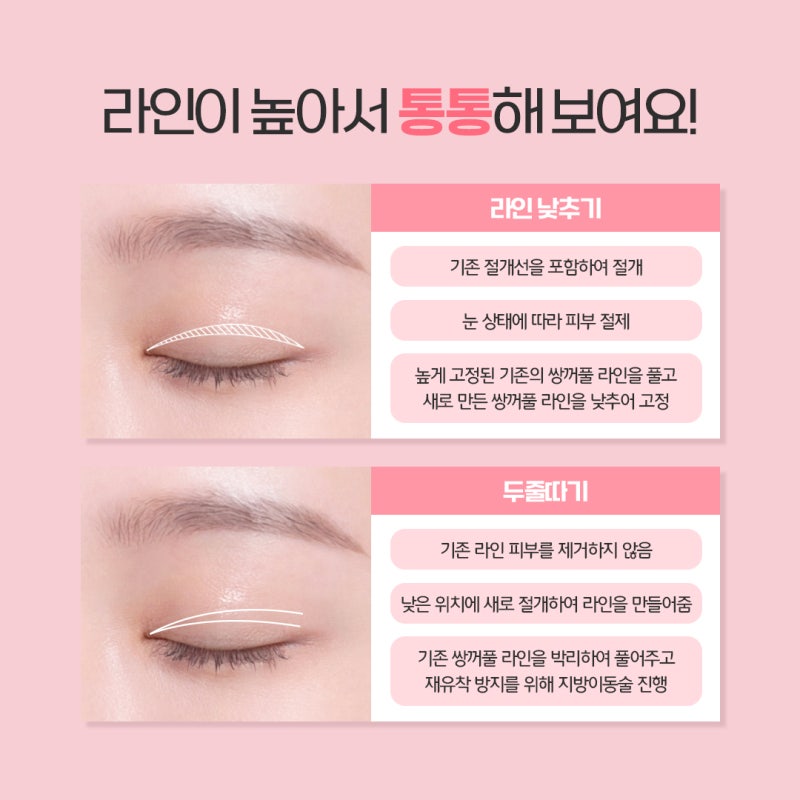 การผ่าตัดแก้ไขตาสองชั้นที่ปูซาน: จุดสำคัญของการลดระดับชั้นตาและเทคนิค ‘สองชั้นซ้อน’