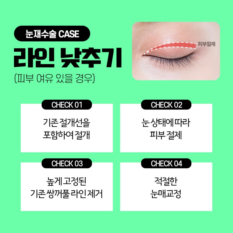 Customized Double Eyelid Revision Surgery Based on Individual Eye Analysis