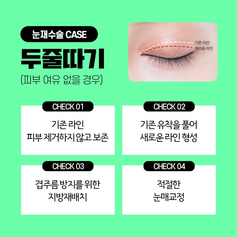 Customized Double Eyelid Revision Surgery Based on Individual Eye Analysis