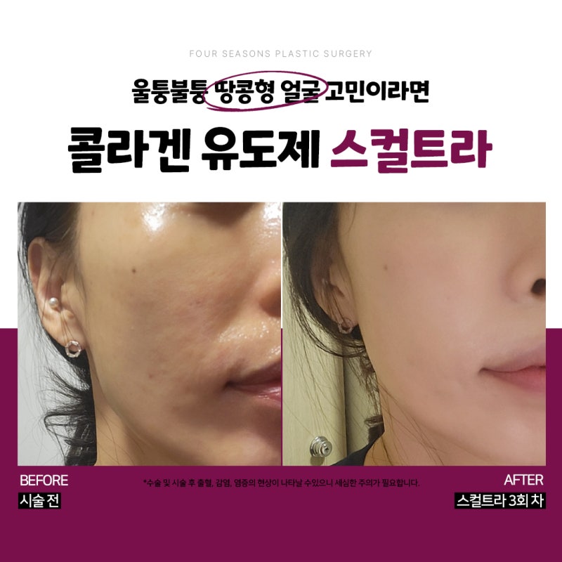 สกินบูสเตอร์ซอมยอน Sculptra เติมคอลลาเจนแทนฟิลเลอร์