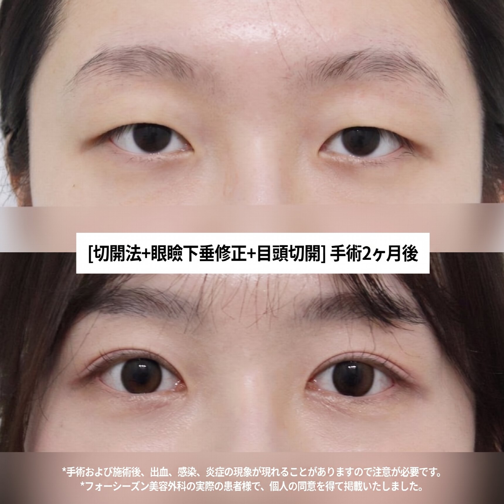 ソミョン二重手術が上手な病院 二重まぶた手術と上眼瞼手術、どんな違いがある？