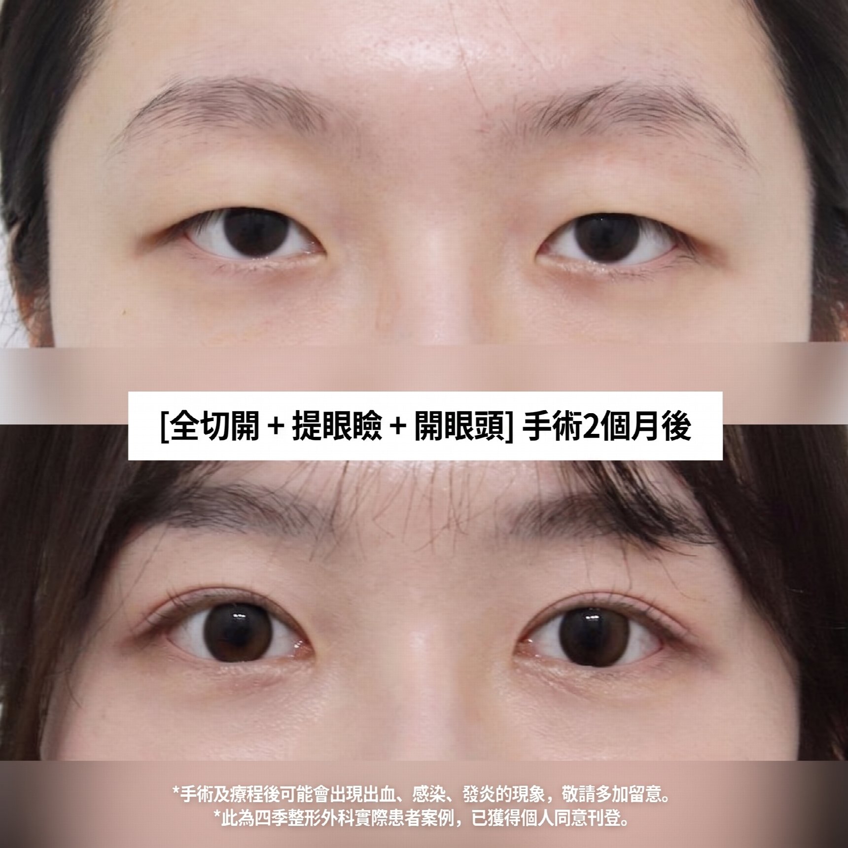 西面雙眼皮手術做得好的地方 雙眼皮手術與上眼瞼手術有何不同?