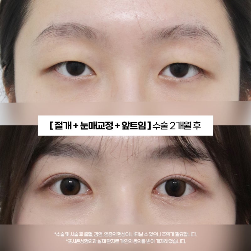 Busan Seomyeon Double Eyelid Surgery: What's the Difference Between Double Eyelid Surgery and Upper Blepharoplasty?