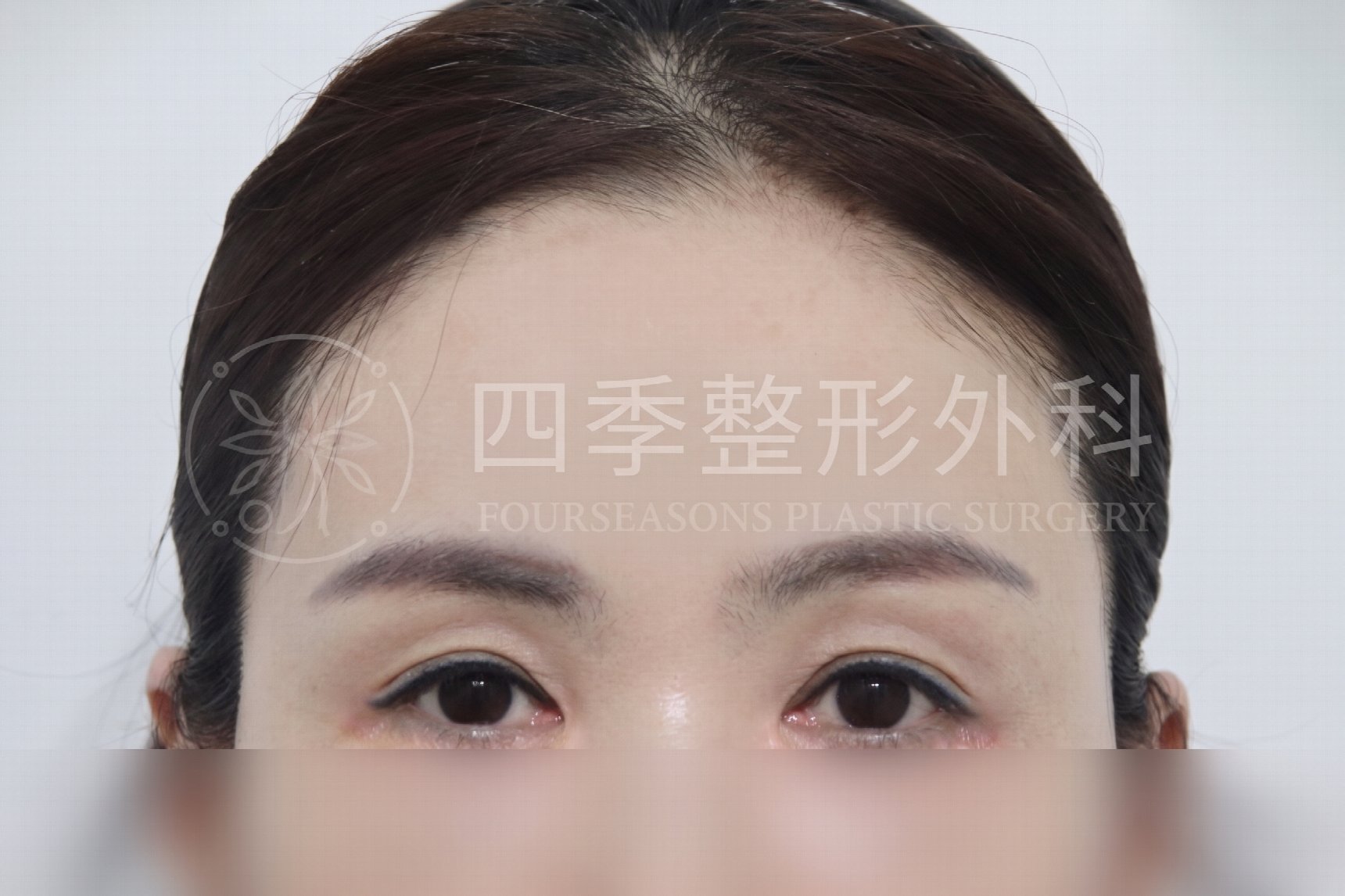 釜山額頭拉提：如果只做雙眼皮手術還不夠